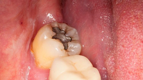 שילובים גנטיים מסוימים עשויים להיות אחראיים על רגישות לכספית