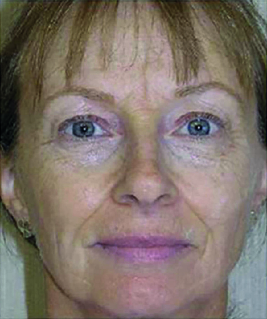 Fig. 1 : Prétraitement et photographies intraorales du visage et des dents antérieures (notez le recouvrement incisif important).