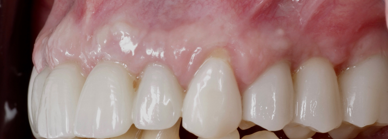 Fig. 16: Left lateral aspect of the restorations.