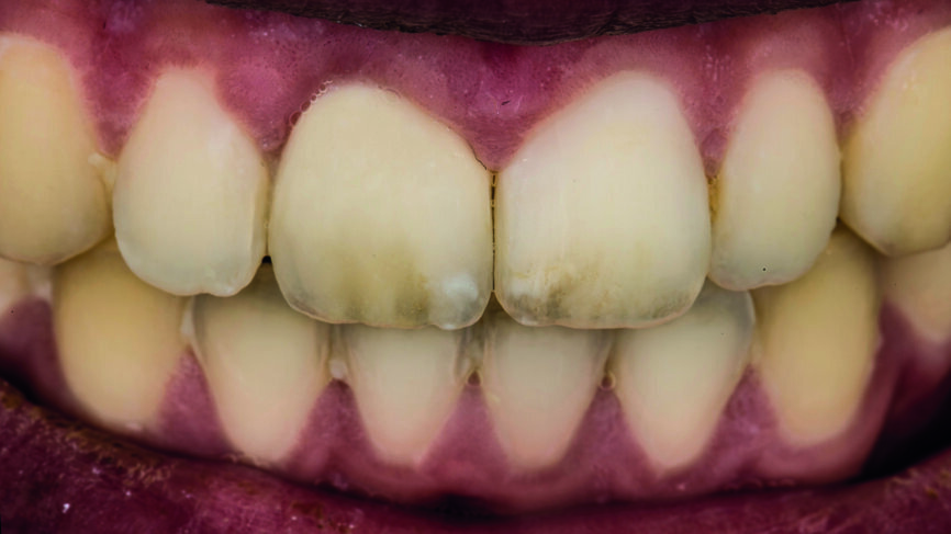 Fig. 14 : Image en polarisation croisée du résultat final.