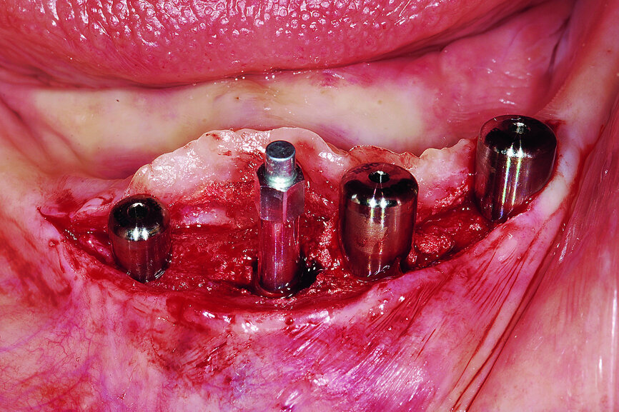 Fig. 19b: Healed site at three months (a). Uncovering of the integrated implants, healing collars and SmartPeg to measure ISQ values postoperatively (b). SmartPeg measuring ISQ values at uncovering (c).