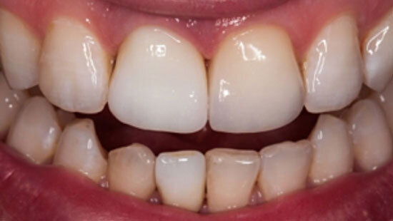 Fig. 10. Tras la cocción de cristalización de ambas coronas completas de cerámica vítrea, se procedió a su prueba en boca.