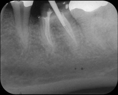 Afb. 5: Edelmetalen stift in het distolinguale kanaal