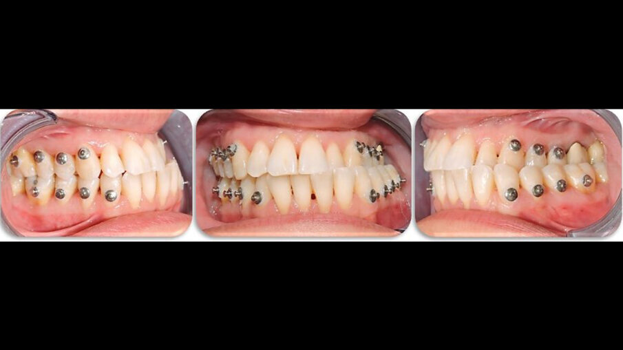 Fig. 5_Bottoni metallici bondati su canini, premolari e primi molari poco prima dell’intervento di chirurgia.