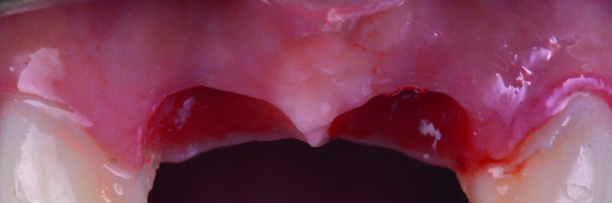 Fig. 30 : Vue de face avant la mise en place des piliers personnalisés. 
