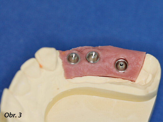 Hlavní model, na kterém je vrchol fixtury zygomatického implantátu umístěn do oblasti palatinálního kořene prvního moláru.