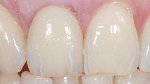 Immediate placement and temporization with a titanium-zirconium dental implant