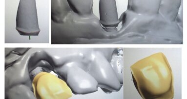 Valoración estética de la restauración protésica sobre implantes