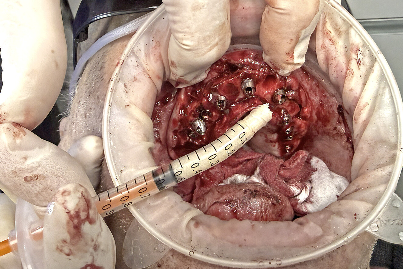 Fig. 23: Filling of the extraction sockets and fenestrations and concavities on the facial aspect with mineralised bone grafting material after removal of the provisional prosthesis.