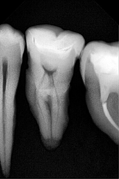 Fig. 45: Radiograph of the restoration.