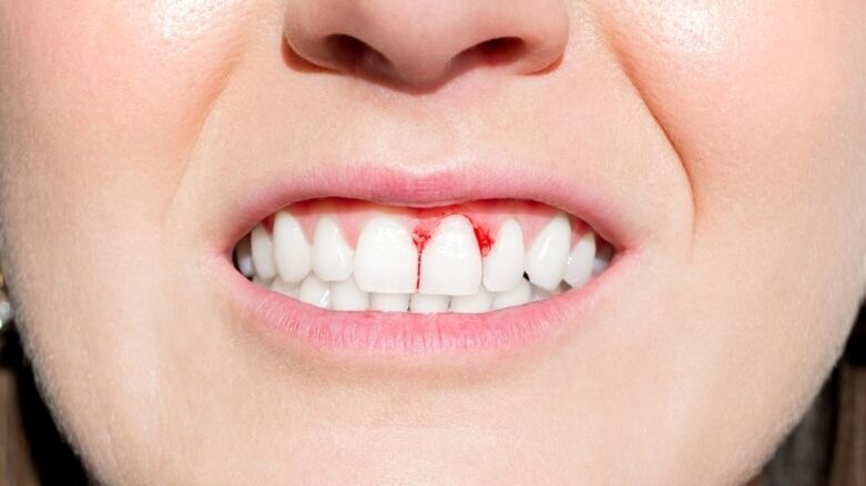 Parodontitis kostte Europa 158,6 miljard euro in 2018