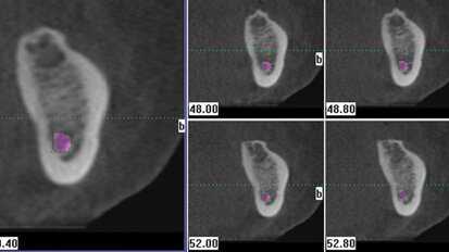 Cone beam — awareness in three dimensions