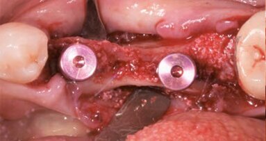 Riabilitazione implanto-protesica minimamente invasiva di una cresta atrofica mediante chirurgia guidata