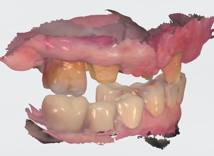 Fig. 7_Visione laterale in posizione centrica dopo la prima preparazione degli elementi naturali.