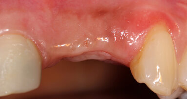 Use of a decalcified cortical bone plate to aid in lateral ridge augmentation