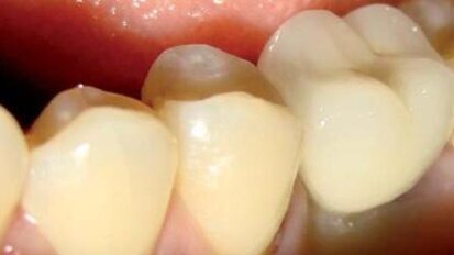 Rekonstrukcja implantoprotetyczna pierwszych trzonowców w żuchwie z wykorzystaniem systemu BEGO Semados®