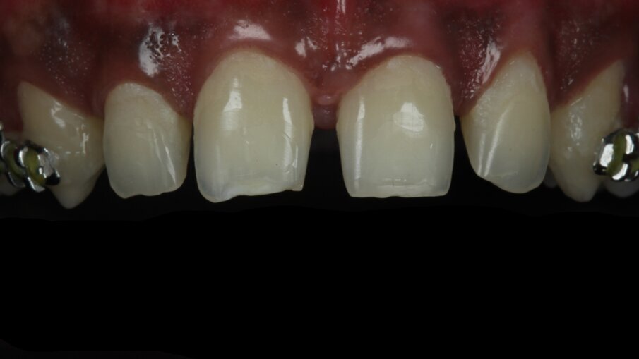 Fig 7: Maxillary incisors brackets debonded