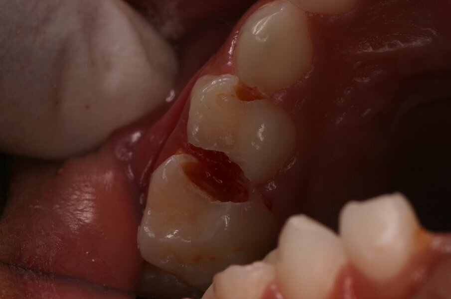 Afbeelding 5b. De gedemineraliseerde caviteitsranden zijn onondersteund en fractureren gemakkelijk door met een glazuurmes erop te drukken. 