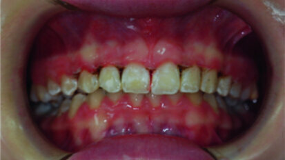 Clinical view just after surgery.