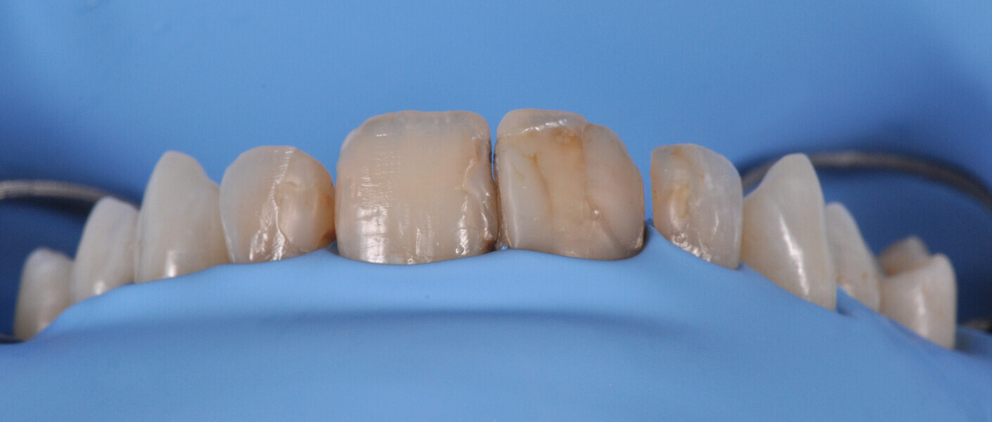 Fig. 7: Operative field isolated with a dental dam.