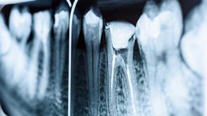 Paciente morre após tratamento de canal devido à anestesia