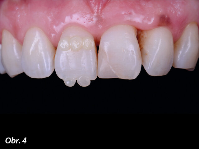 Výběr odstínu pomocí tzv. kompozitní „knoflíkové“ techniky (Composite Button Technique), s (4) a bez (5) polarizačních filtrů.