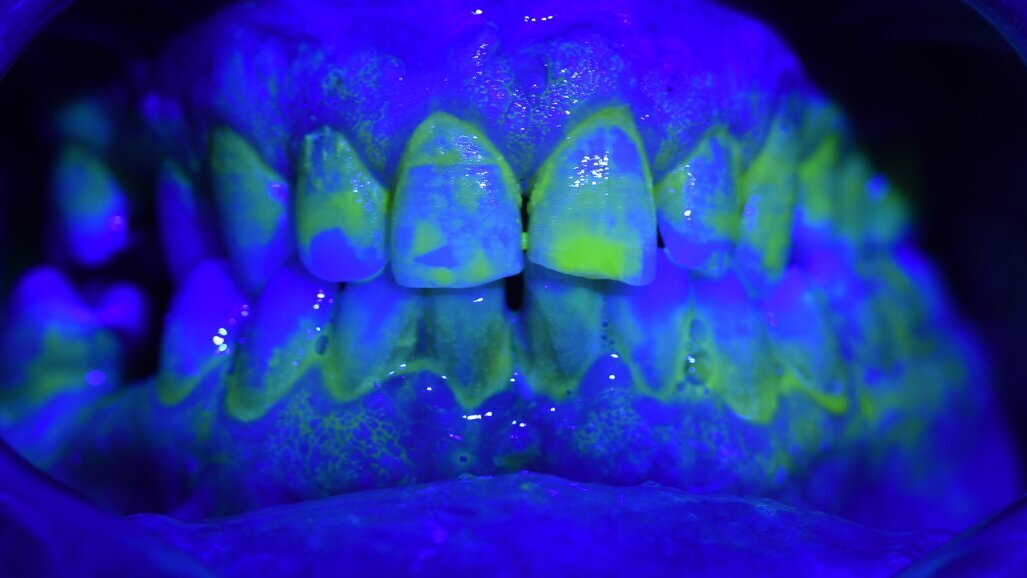 Il Tailored Brushing Method (T.B.M.): un approccio efficace per il controllo del biofilm batterico