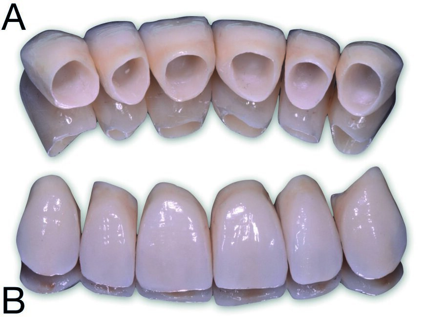 Fig. 7 : Couronnes unitaires antérieures en zircone cubique stratifiée. a : vue de l’intrados; b : vue vestibulaire. 