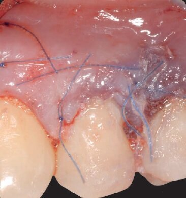 Fig. 10 - Suture e cianoacrilato.