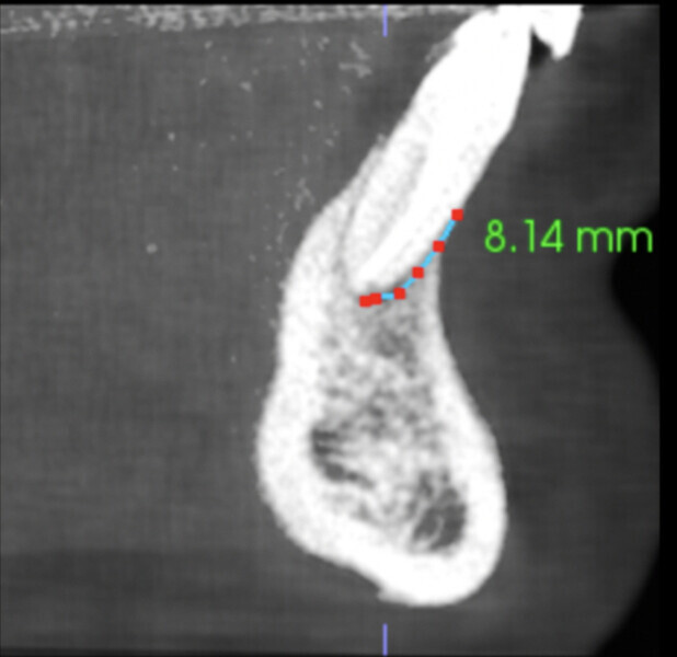 Fig. 6b: Vertical views of both central incisors showing bone healing under the apices and bone growing vertically on the buccal aspect (b & c).