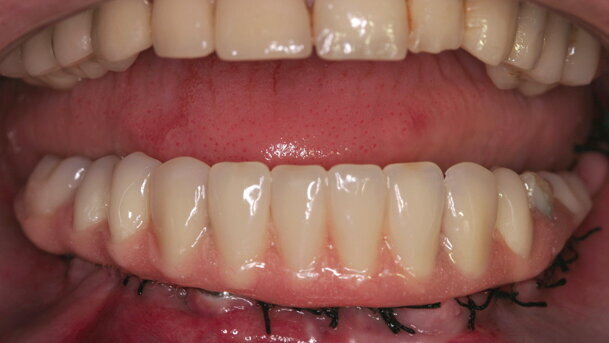 The ‘All-on-4’ implant concept for edentulous jaws