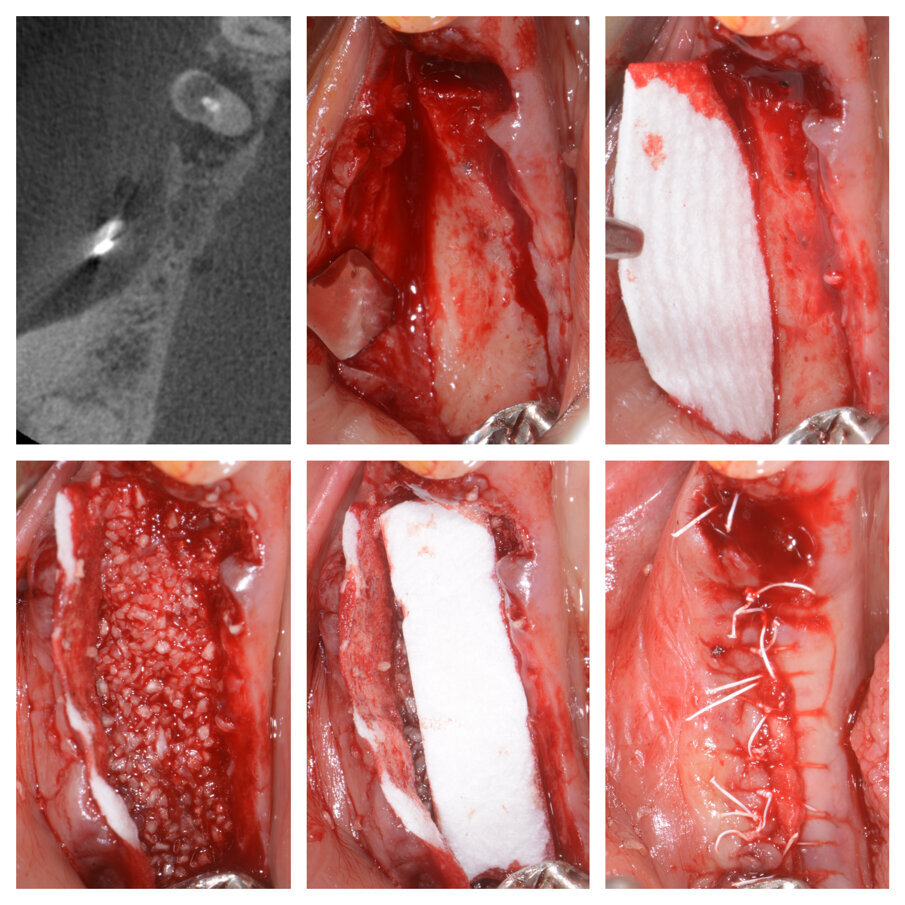 Fig. 3a_Tecnica S.A.T. applicata in zona 44-45-46.