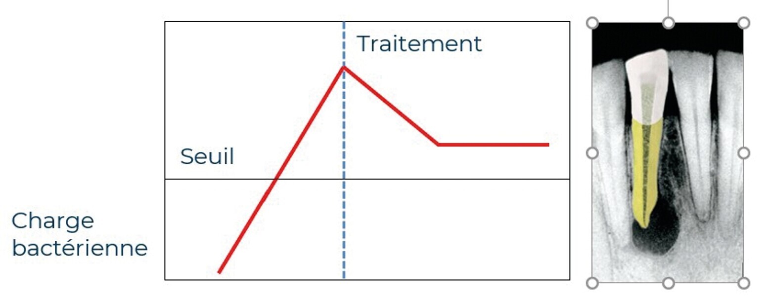Fig. 5 : Illustration de la persistance d’une lésion malgré un traitement canalaire, lorsque l’on n’est pas parvenu à passer sous la valeur du seuil.
