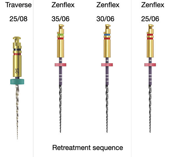 Slika br. 1a–d: Sekvenca za retretman. 25/.08 Traverse turpija (a). 35/.06 ZenFlex turpija (b). 30/.06 ZenFlex turpija (c). 25/.06 ZenFlex turpija (d)