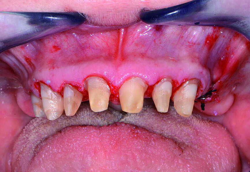 Fig. 6: Prepared maxillary and mandibular teeth with implants already placed.