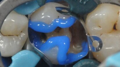 Behandeling van een falende restauratie 26 met behulp van SDR en Ceram-X Universal