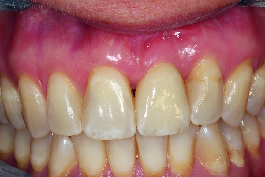 Fig. 12b: Clinical situation at the examinations after a) six and b) 12 months.