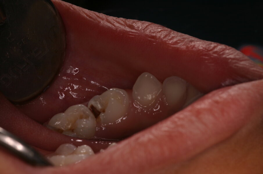 Afbeelding 3a. Het glazuurmes wordt op het onondersteund, gedemineraliseerde glazuur van de caviteitsrand geplaatst. 