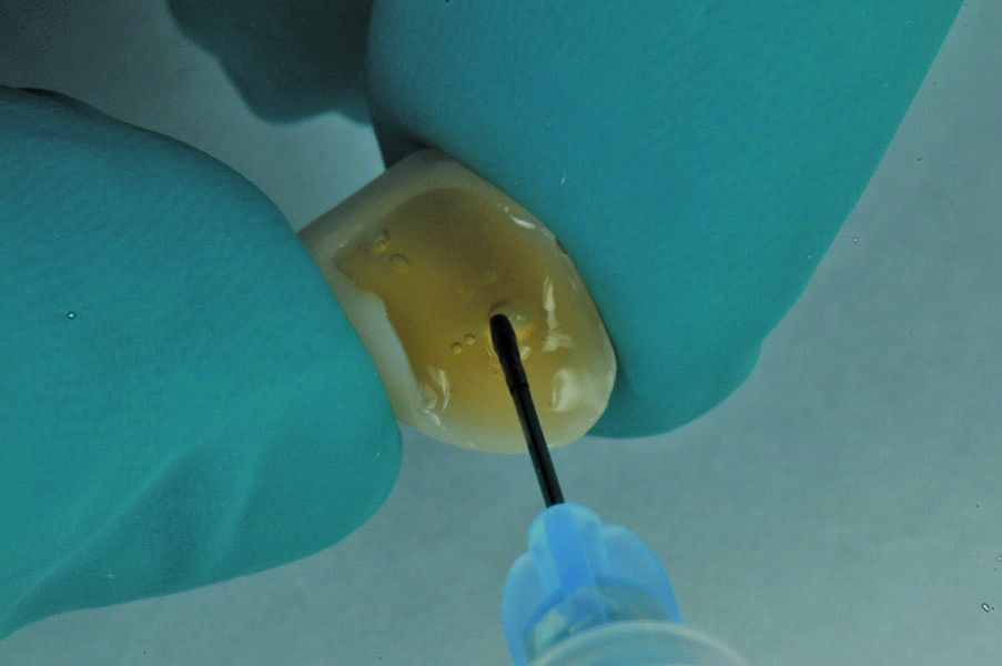 Fig. 12: After etching with hydrofluoric acid the veneers are silanised with 3M™ Single Bond Universal Adhesive, rubbing it in for 20 seconds and then air thinning it gently until no more ripples are observed.