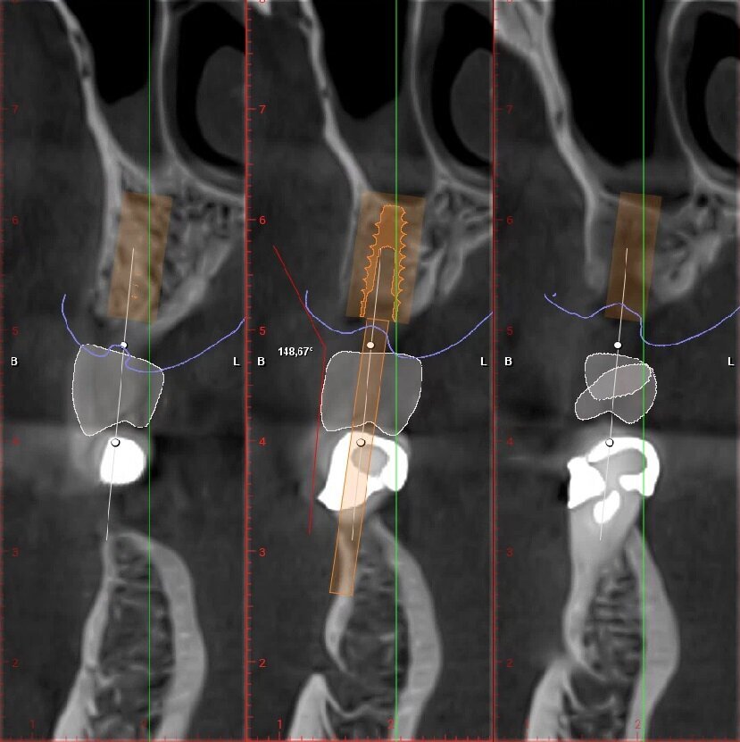 Fig. 8_Valutazione angolo di emergenza della protesi elemento 2.5, valore 148,67°..