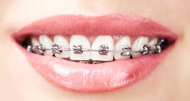 Mundhygiene-Experten forschen an neuer Bracket-Reinigung