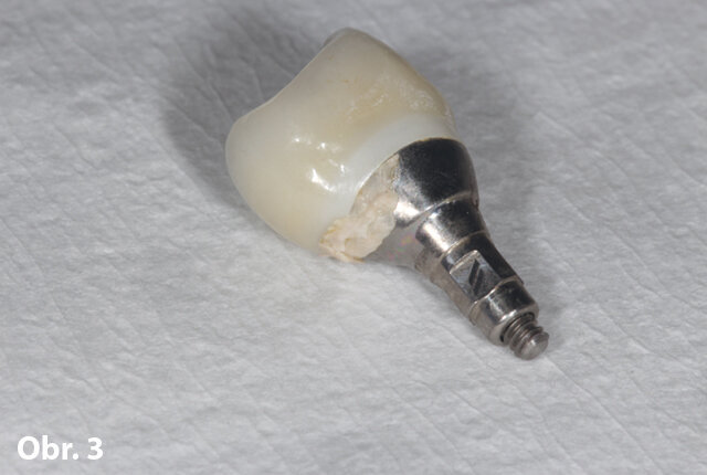 Dobře designovaný abutment, který byl špatně dosazený