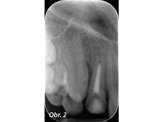 Obr. 2: Stav po zaplnění