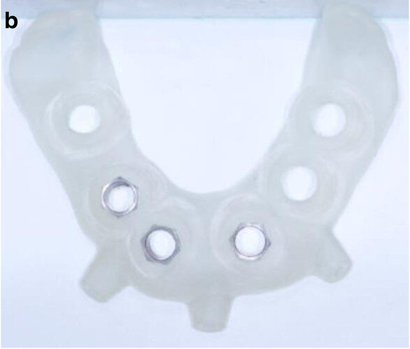 Fig. 5b: CAD/
CAM-fabricated surgical guides: tooth- and mucosa- supported (a) and implant- and mucosa-supported (b).