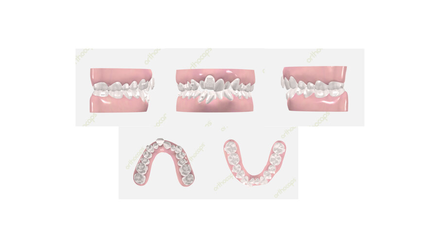 Figg. 11-15_Modelli dentali digitali iniziali.