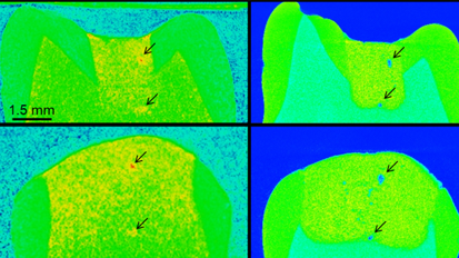 Zubereitung bei Zahnfüllmaterialien entscheidend