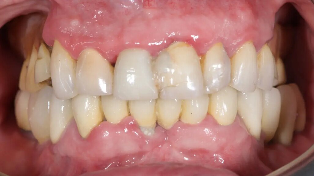 Нов дигитален протокол за възстановяване на цяла зъбна дъга