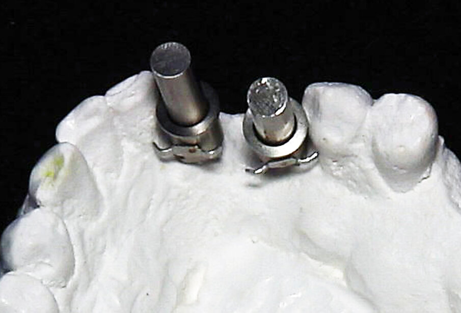 Fig. 10: The cleats on the guide sleeves were orientated to maximise retention in the resin to be placed to fabricate the surgical guide.