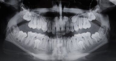 Management ortodontico delle trasposizioni dentali