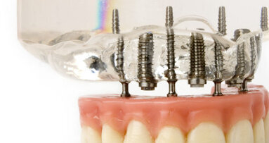 US scientists develop smart coating for dental implants